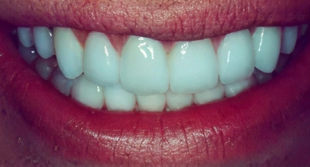 Close-up of a bright, healthy smile showing white teeth and pink lips against a neutral background.