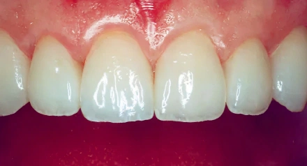 Close-up view of upper front teeth showing dental work and gum tissue against purple background.