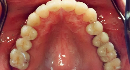 Intraoral view of upper dental arch showing aligned teeth and palate during dental examination.