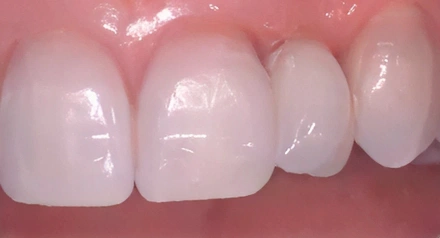 Close-up view of four white dental crowns or veneers on natural teeth in mouth.