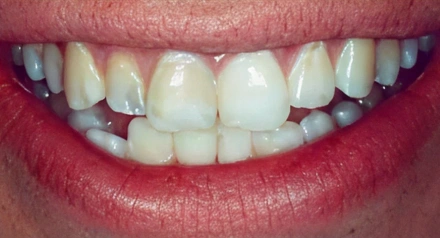 Close-up of a person's smile showing upper and lower teeth with visible gaps and discoloration.