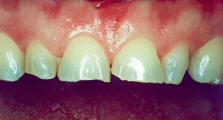 Close-up of upper front teeth showing gum inflammation and discoloration with yellowish tooth appearance.