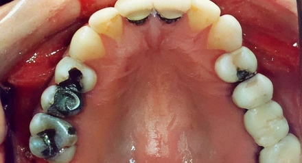 Intraoral view of upper teeth showing dental work and tooth discoloration in patient's mouth.