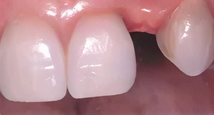 Close-up of three polished dental crowns or veneers on upper front teeth showing glossy finish.