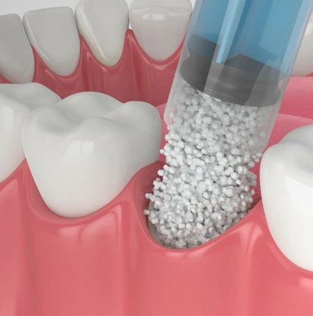Dental implant procedure showing bone graft material being placed into jaw socket for tooth restoration.