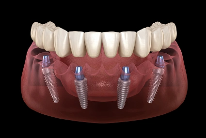 Dental implants model showing four titanium posts in jawbone with ceramic crown restoration