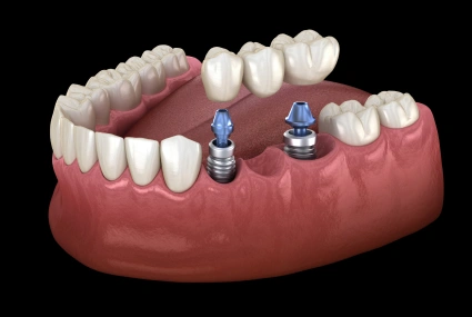 Dental implants in jawbone model showing two blue implant posts with artificial teeth.