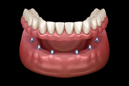 Digital illustration of dental implant placement showing implant posts in jawbone with prosthetic teeth.