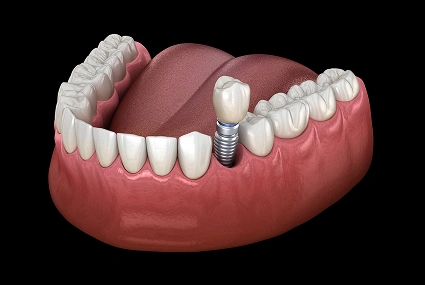 Dental implant model showing titanium post inserted in gum with artificial crown tooth beside natural teeth.