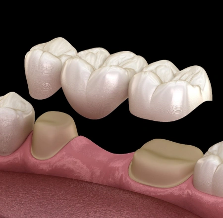 Img-metal-free-crowns