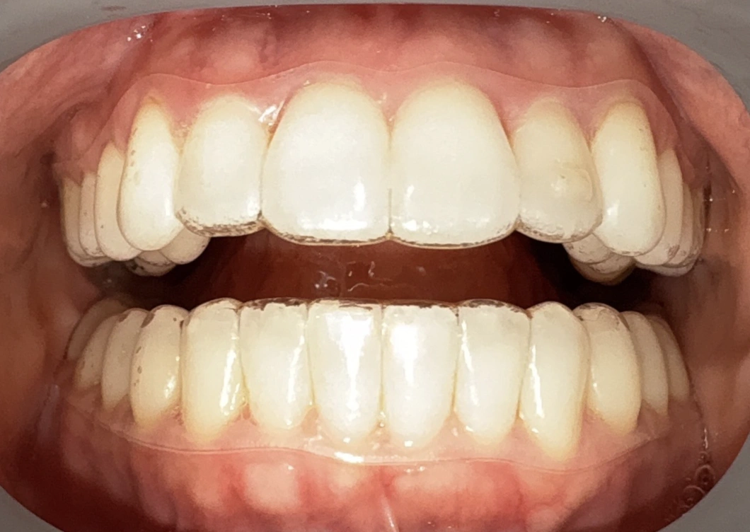 Close-up view of a patient's smile displaying bright, well-aligned upper and lower teeth with healthy gums.