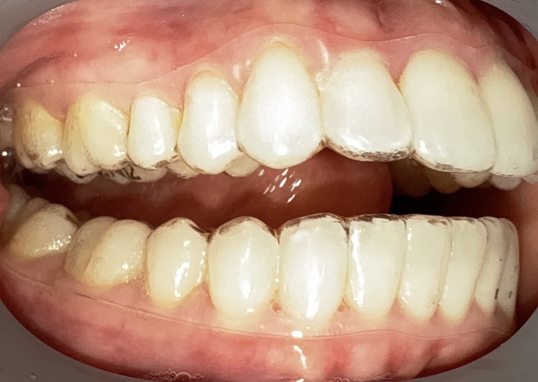 Close-up view of upper and lower teeth showing natural tooth color and alignment in dental examination.