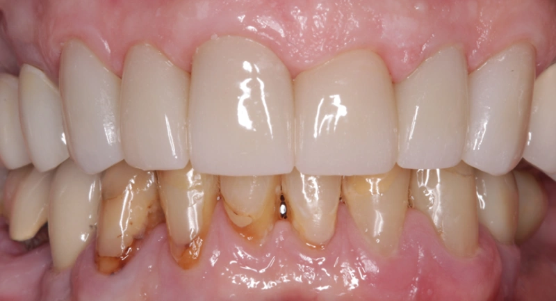 Close-up of dental work showing upper front teeth restoration with lower natural teeth visible in mouth.