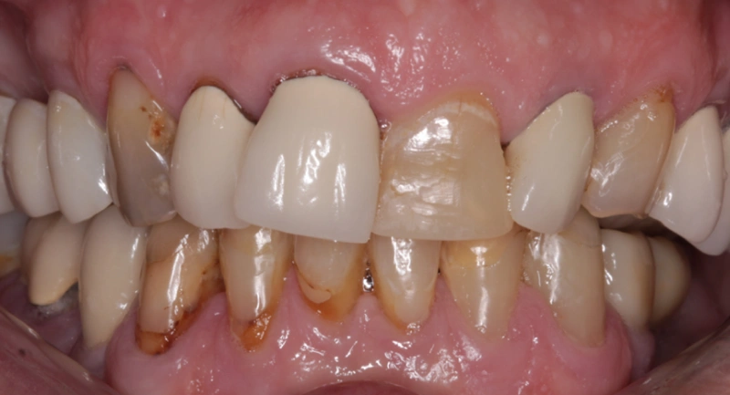 Close-up of discolored and stained upper and lower teeth showing dental discoloration and decay.