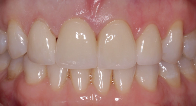 Close-up view of upper front teeth showing dental work and natural tooth alignment in clinical setting.