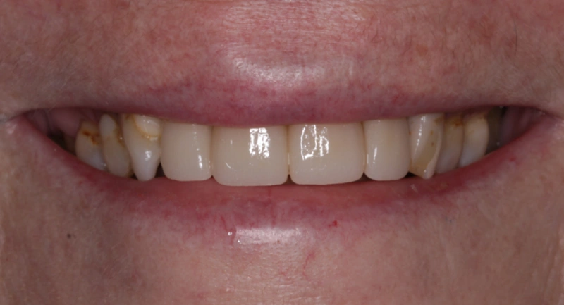Close-up of front teeth showing discoloration and spacing issues requiring dental treatment.