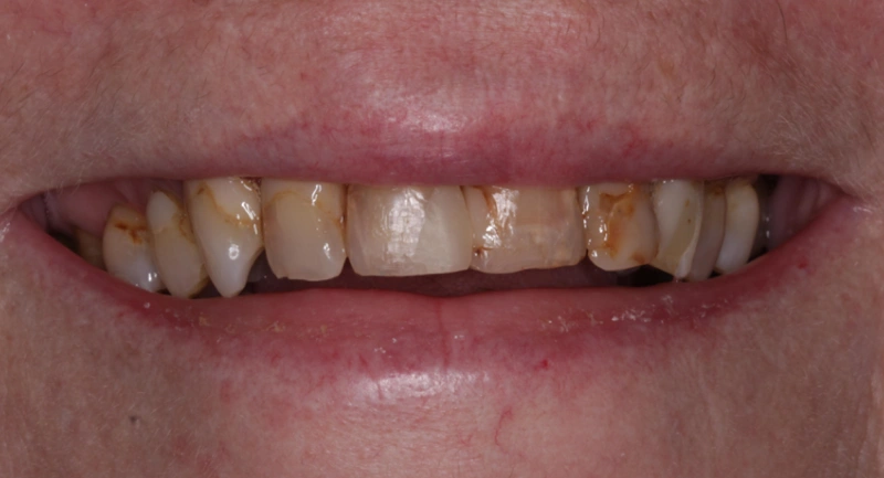 Close-up of discolored and misaligned upper teeth showing dental treatment needs.