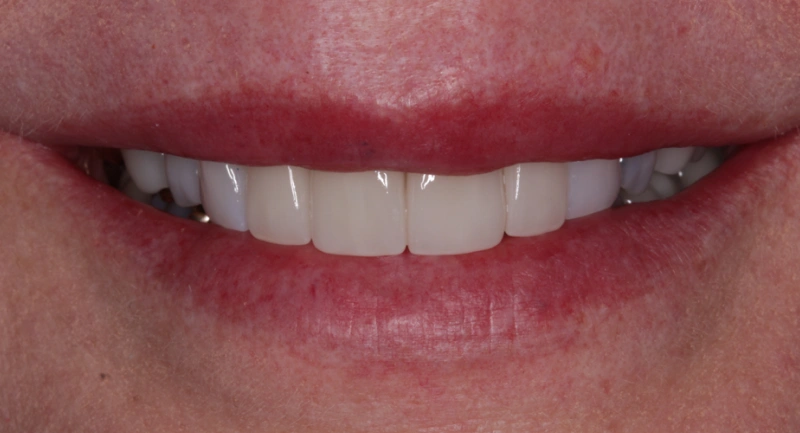 Close-up of a person's smile showing white teeth and natural lips against skin tone.