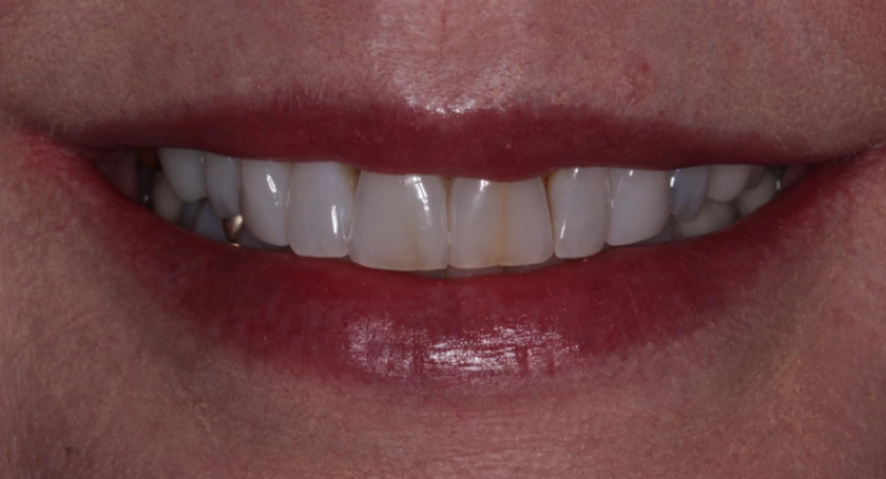 Close-up of person's smile showing teeth and lips in dental context.