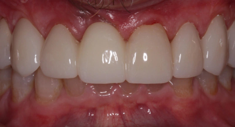 Close-up view of upper front teeth showing dental work and gum health in clinical setting.