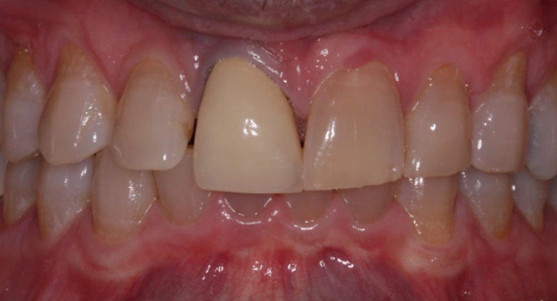 Close-up view of upper front teeth showing dental work and gum health during oral examination.