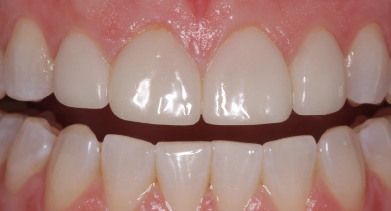 Close-up of upper and lower front teeth showing bright, white dental work and healthy gums.