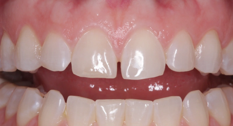 Close-up of upper front teeth showing dental work or whitening results in clinical setting.